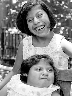 Former Conjoined Twins Turn 10 Years Old