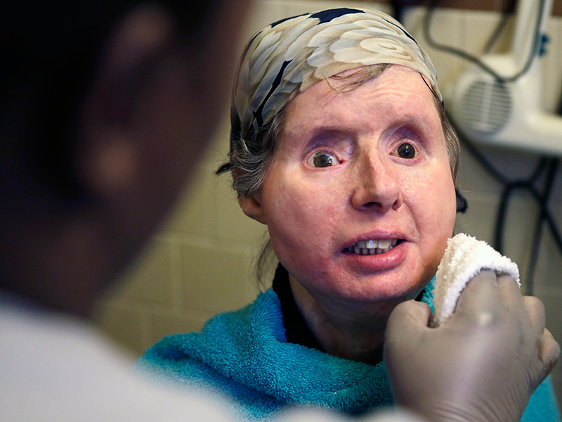Chimp Victim Charla Nash Back in Hospital to Fight Rejection of Face Transplant