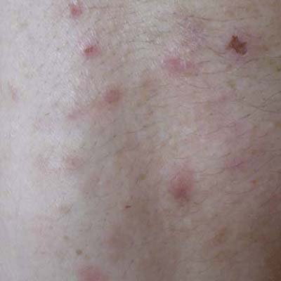 bedbug bites on arm