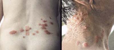 bedbug victims and their bites
